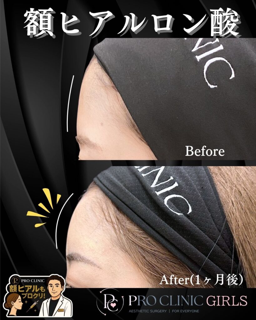 プロクリニックの額ヒアルロン酸注入の症例(1ヶ月後・横)