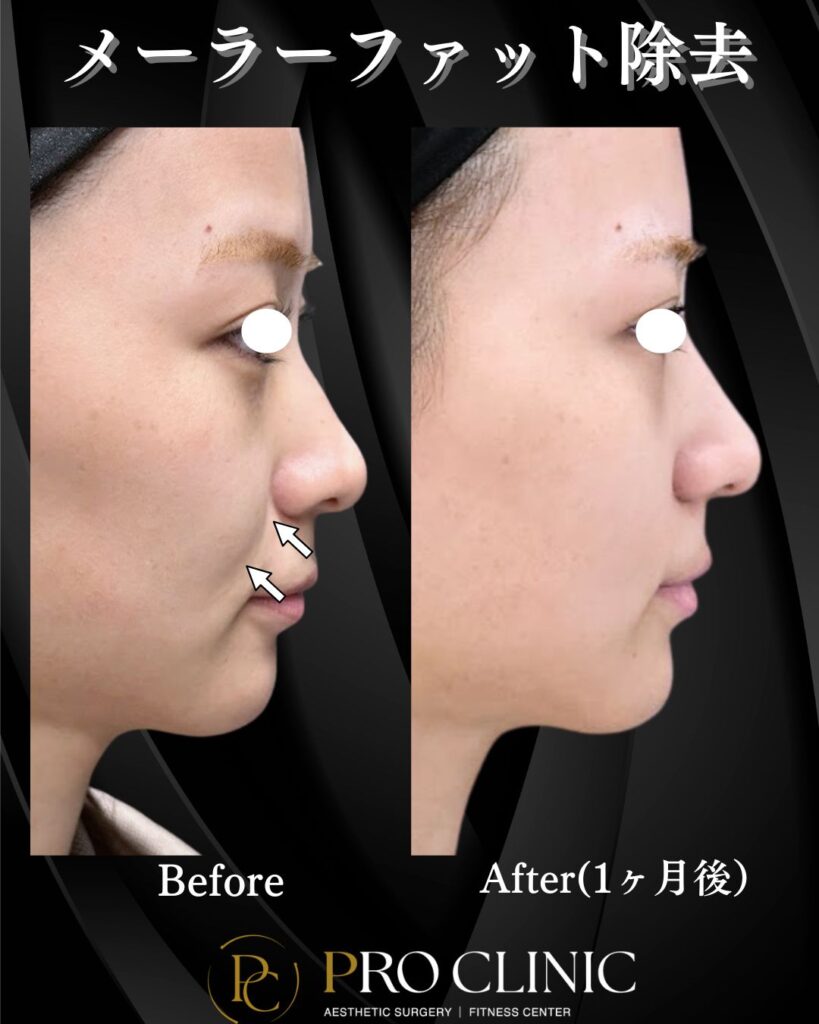 プロクリニックのメーラーファット除去の症例（1か月後・横）