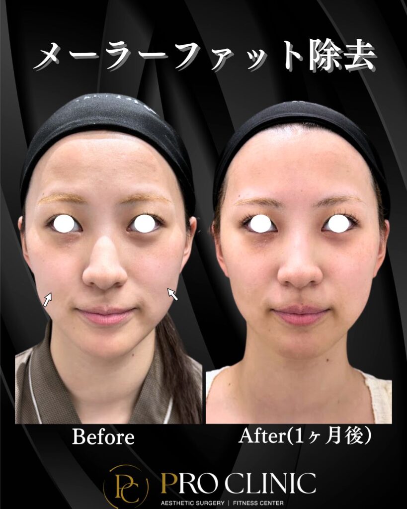 プロクリニックのメーラーファット除去の症例（1か月後・正面）