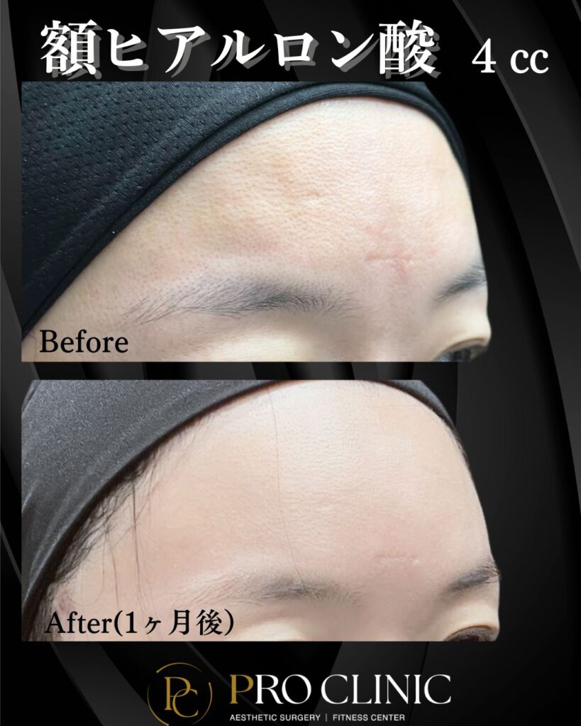 プロクリニックの額ヒアルロン酸注入の症例(1ヶ月後・斜角)