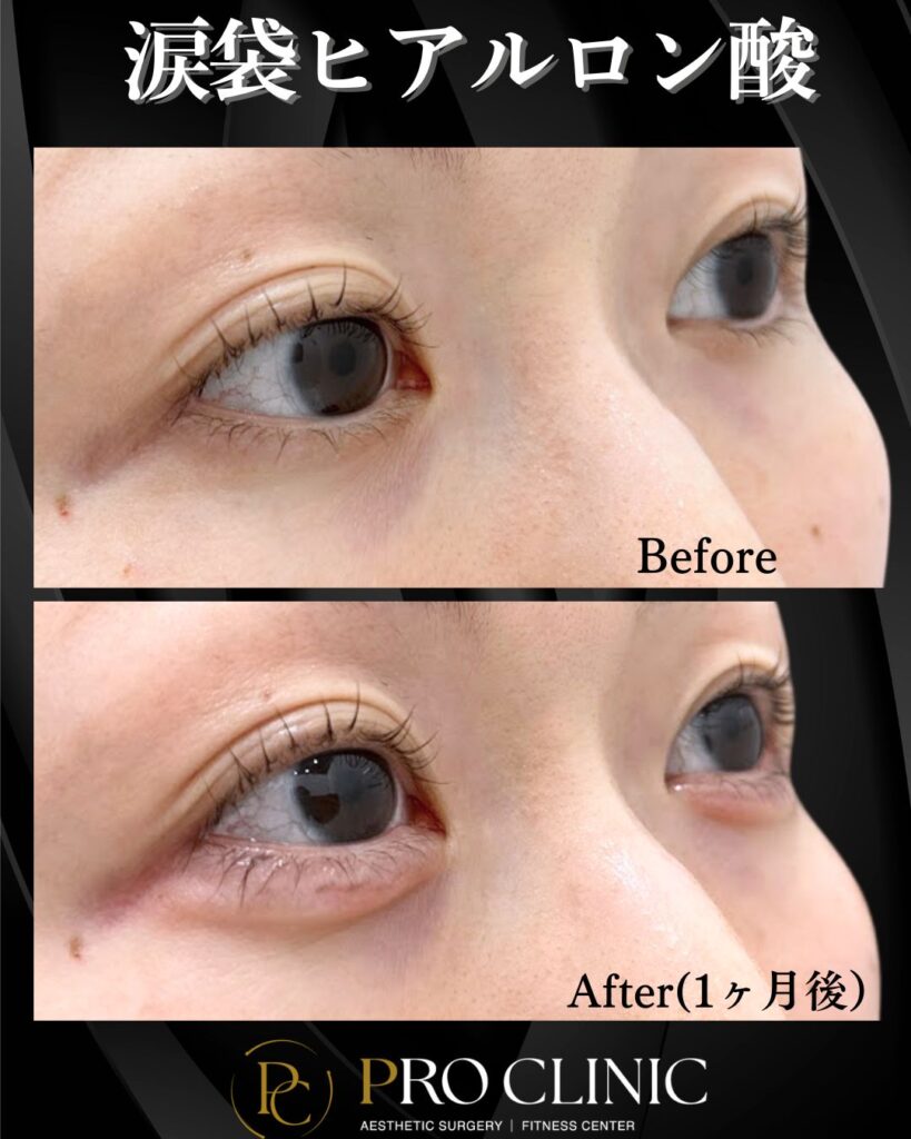プロクリニックの涙袋ヒアルロン酸の症例(1ヶ月後・斜め)。施術前(Before)と比べ、施術後(After)は涙袋が自然に形成され、目元に立体感が出ている様子。