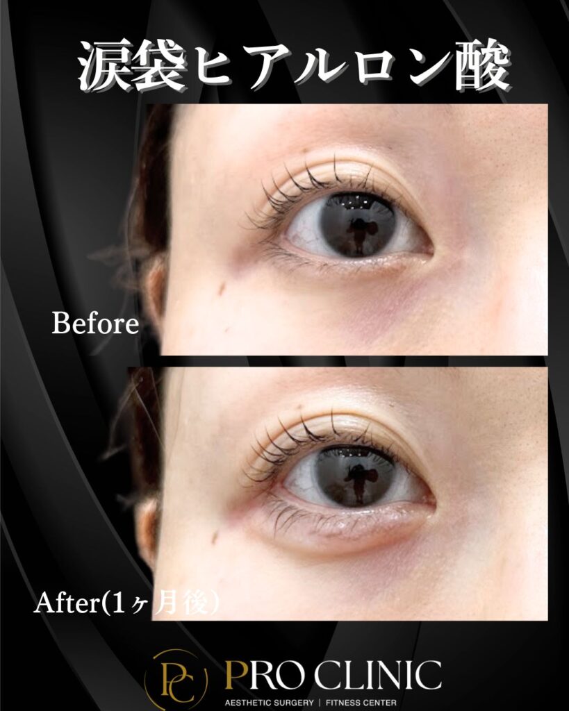 プロクリニックの涙袋ヒアルロン酸の症例(1ヶ月後・正面)。施術前(Before)の平坦な目元と比べ、施術後(After)は目頭から中央にかけて自然な涙袋が形成され、優しいお目元になっている。