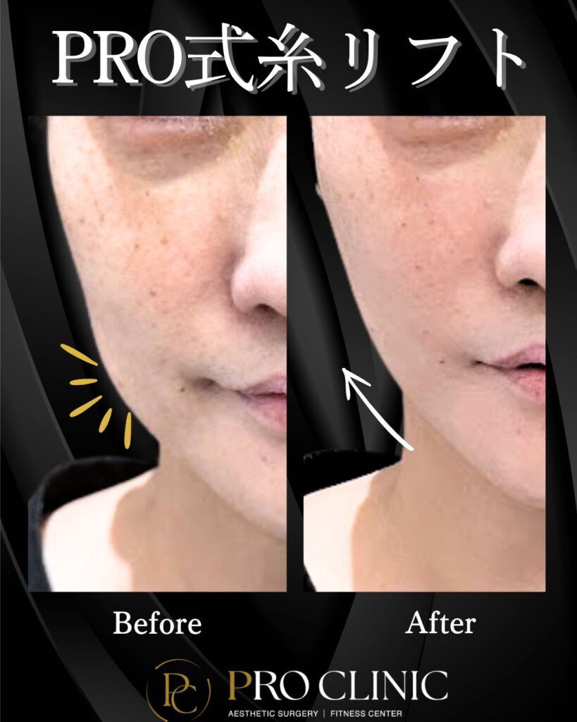 プロクリニックのプロ式糸リフトの症例（1か月後・正面）