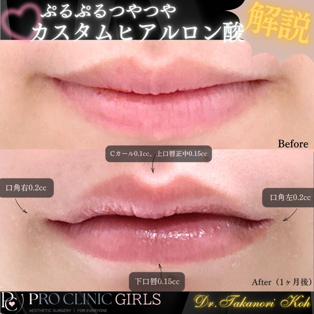 プロクリニックのリップヒアルロン酸注入の症例（1か月後・正面）