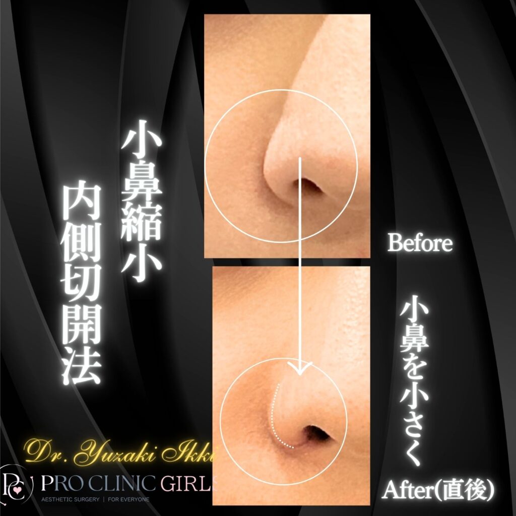 プロクリニックの小鼻縮小術切開法の症例（術後・正面）