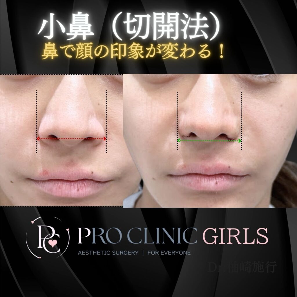 プロクリニックの小鼻縮小術内側切開法の症例（術直後・正面）