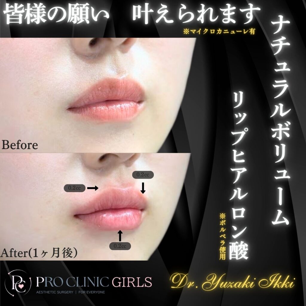 プロクリニックのリップヒアルロン酸の症例（1ヶ月後・斜角）