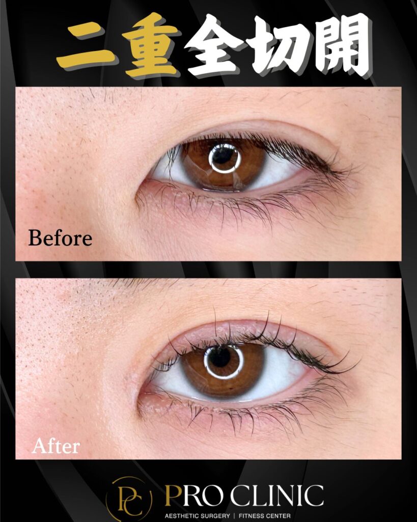 プロクリニックの二重形成術全切開法の症例（1か月後・正面）