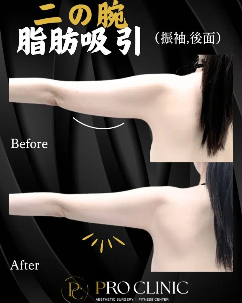 プロクリニックの3D脂肪豊胸術に伴う二の腕脂肪吸引の症例（１か月後・背面）