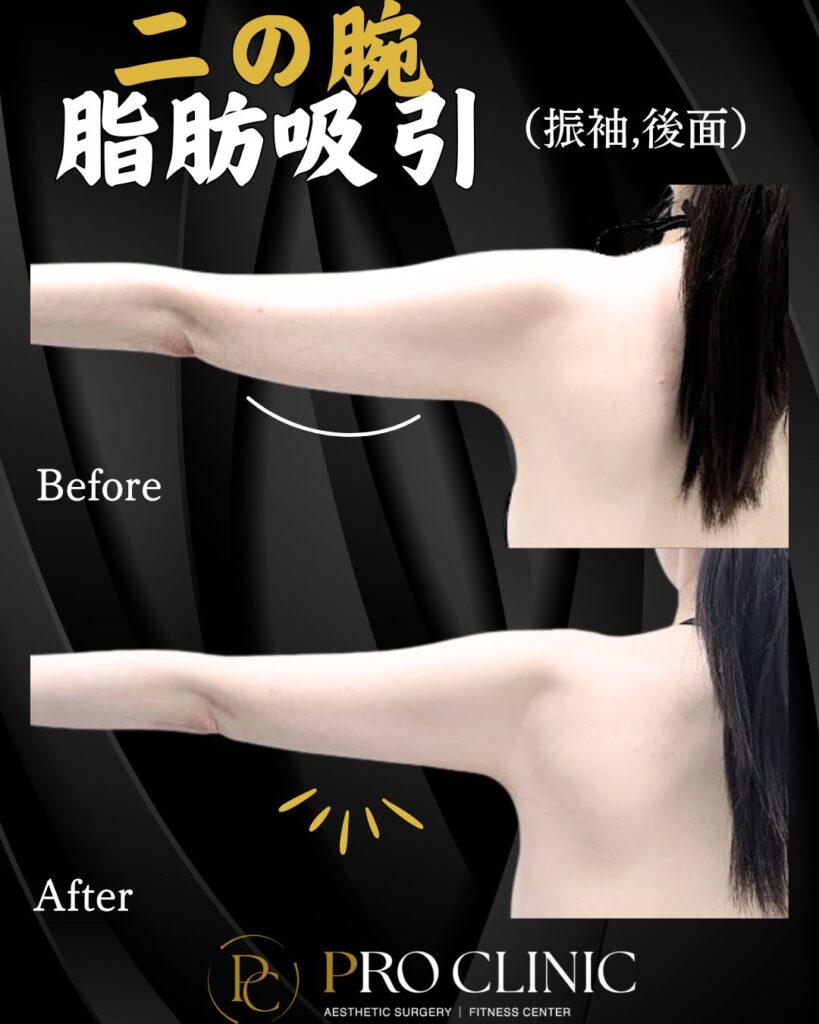 プロクリニックの3D脂肪豊胸術に伴う二の腕脂肪吸引の症例（１か月・背面）