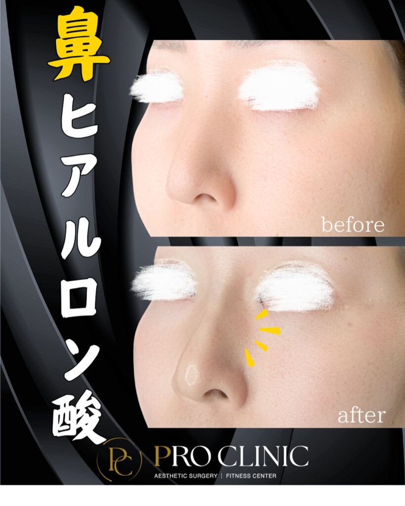 プロクリニックの鼻ヒアルロン酸注入の症例（１か月・斜角）