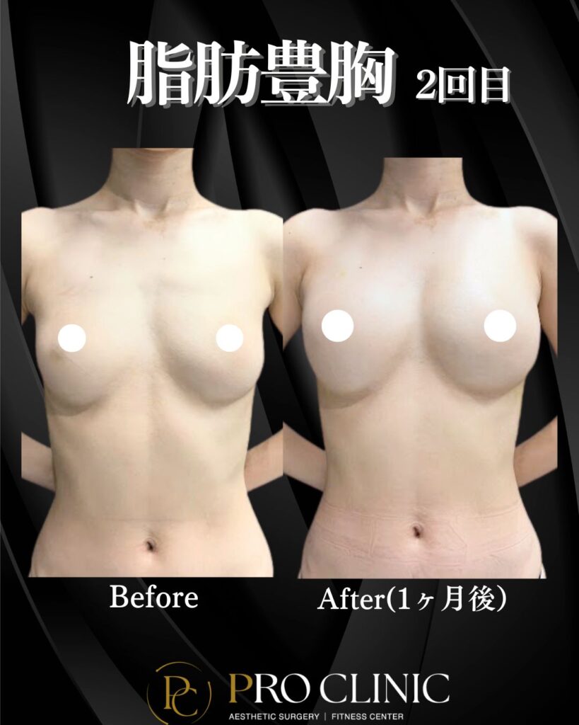 プロクリニックの脂肪豊胸術の症例（１か月後・背面）