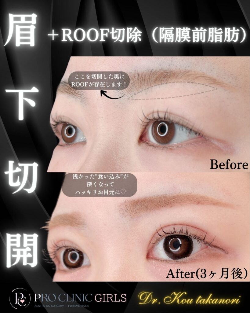 プロクリニックの眉下切開の症例（1か月後・斜角）
