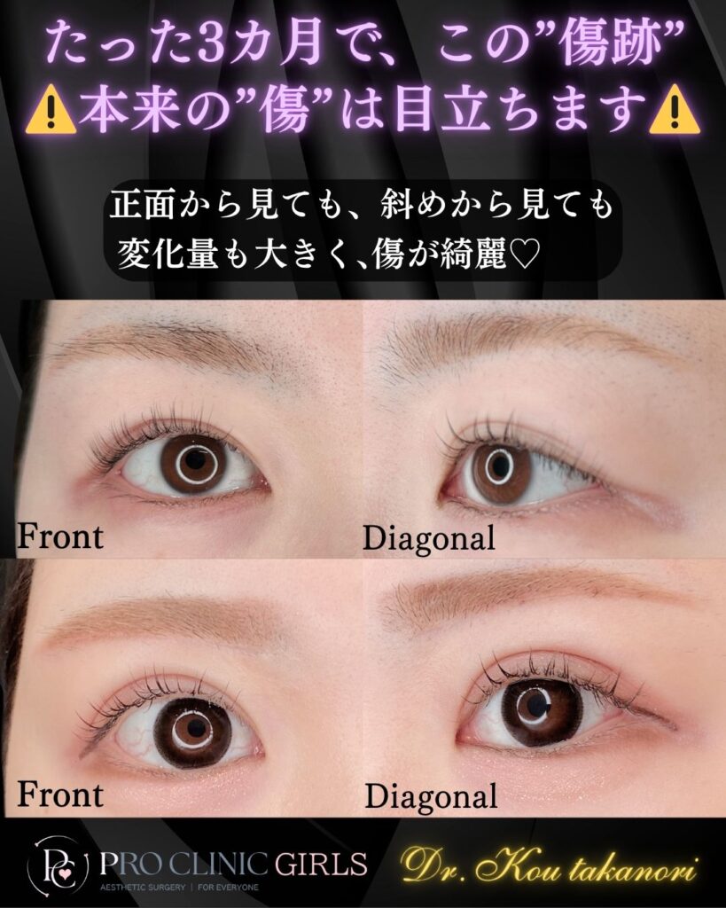 プロクリニックの眉下切開の症例（3か月後・正面/斜角）