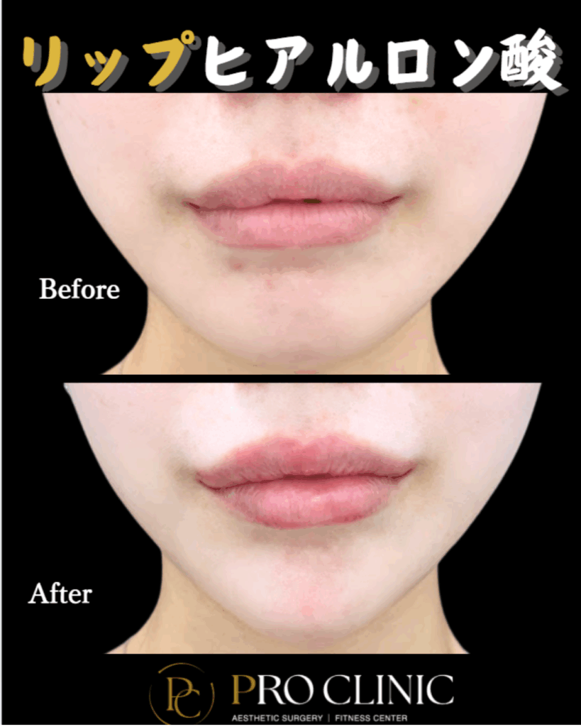 プロクリニックのリップヒアルロン酸注入の症例（1か月後・正面）