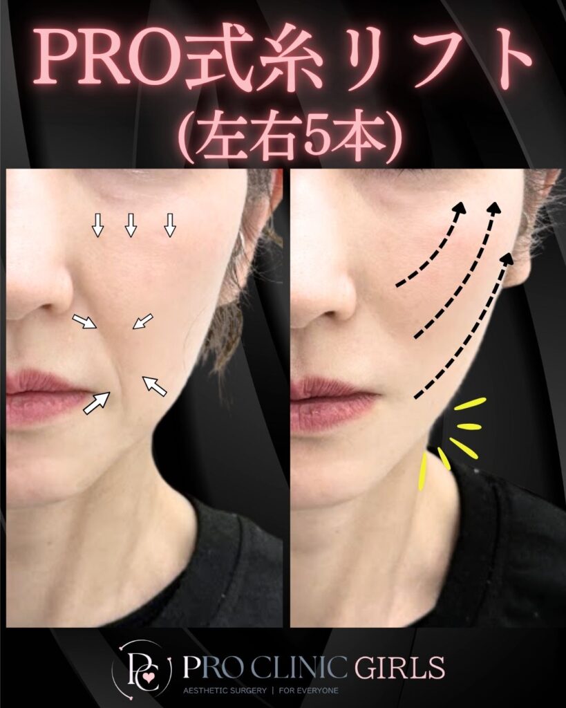 プロクリニックのPRO式糸リフト（左右5本）の症例（1か月後・正面）