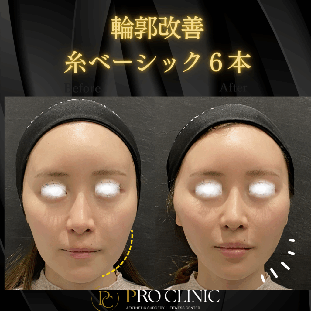 プロクリニックの糸リフトの症例（1か月後・正面）