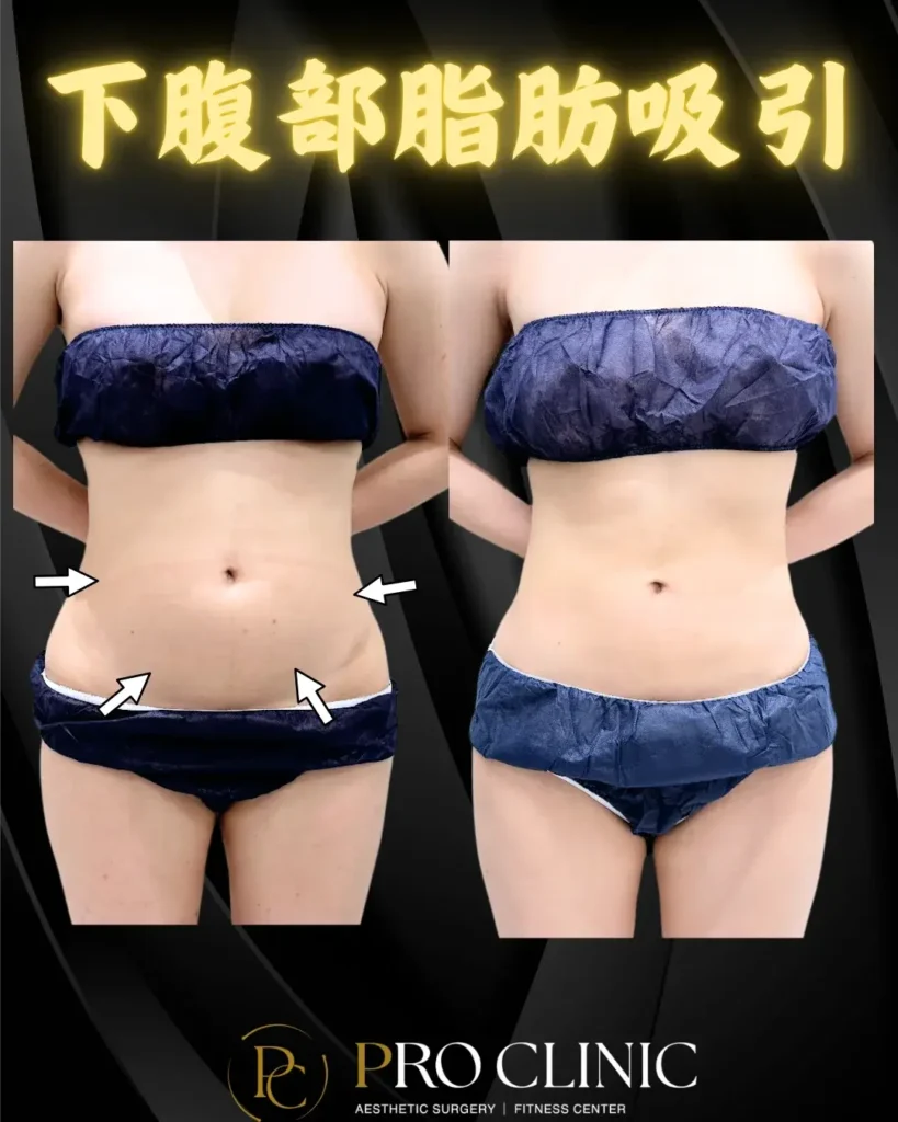 プロクリニックの下腹部脂肪吸引の症例（3か月後・正面）