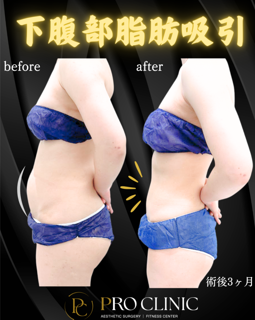 プロクリニックの下腹部脂肪吸引の症例（3か月後）