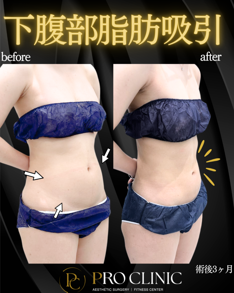 プロクリニックの下腹部脂肪吸引の症例（3か月後）