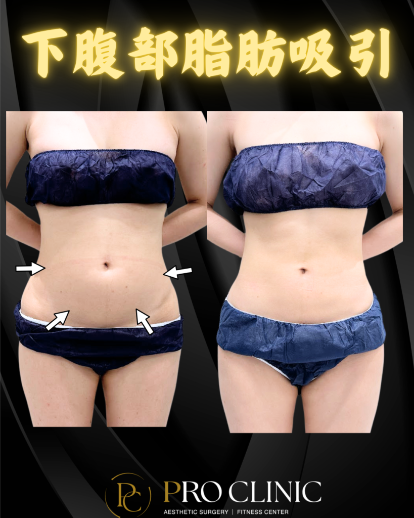 プロクリニックの下腹部脂肪吸引の症例（3か月後・正面）