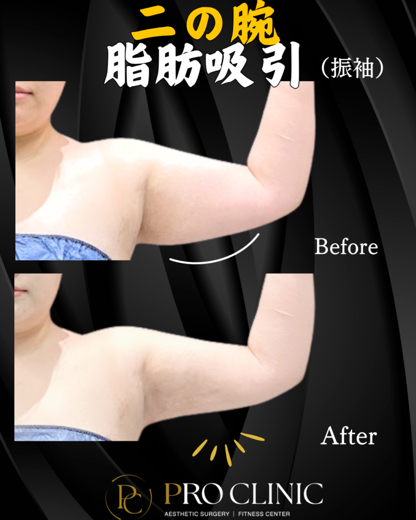 プロクリニックの二の腕脂肪吸引の症例（3か月後・正面）