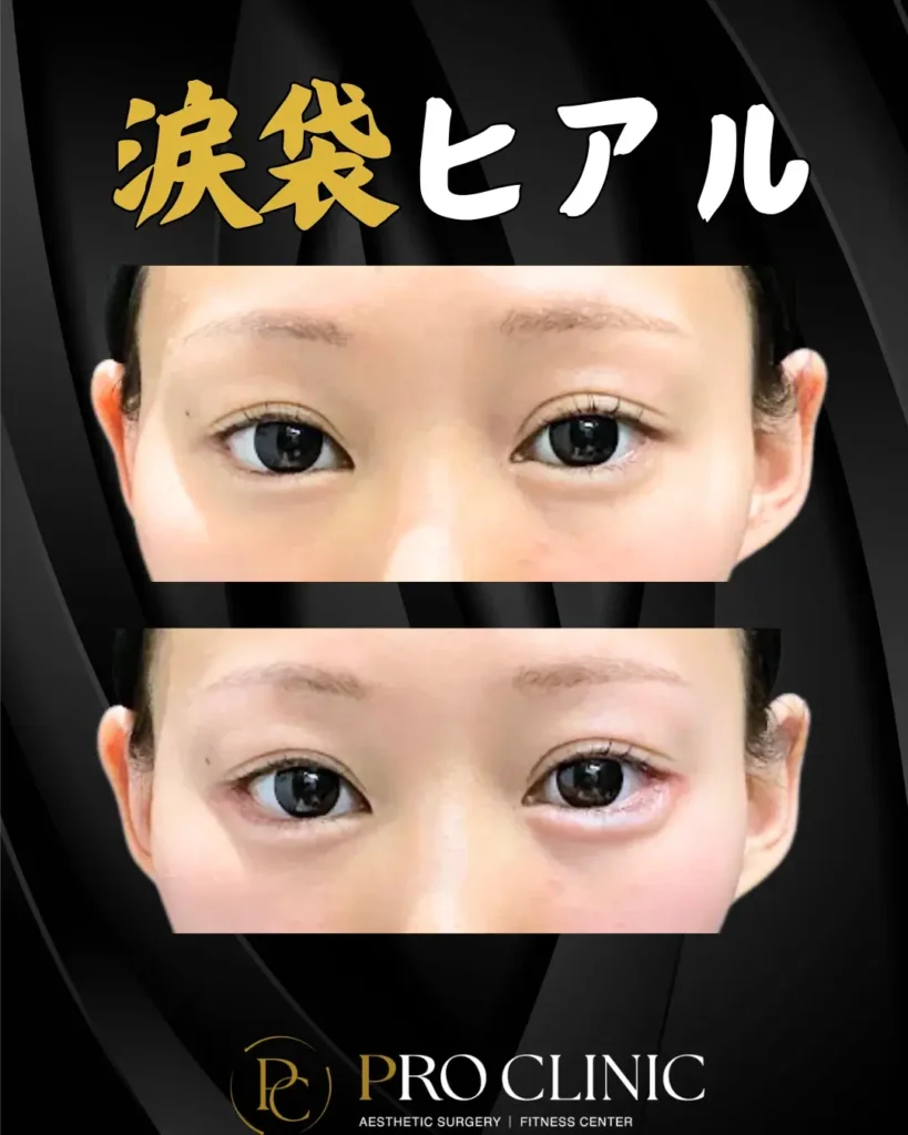 プロクリニックの涙袋ヒアルロン酸の症例(1か月後・正面)