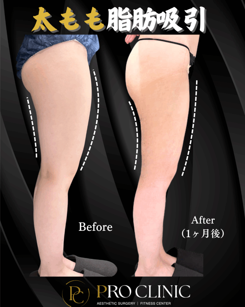 プロクリニックの太もも脂肪吸引の症例(1か月後・横)