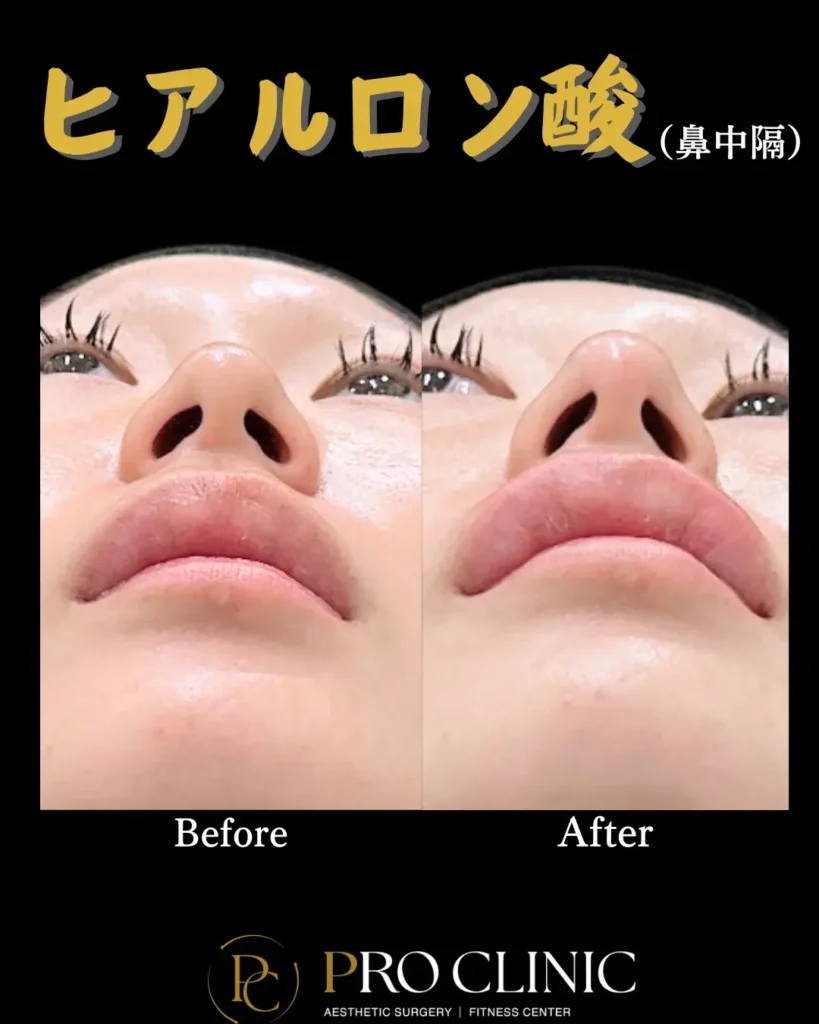 プロクリニックの鼻中隔ヒアルロン酸注入の症例（1か月後・正面）