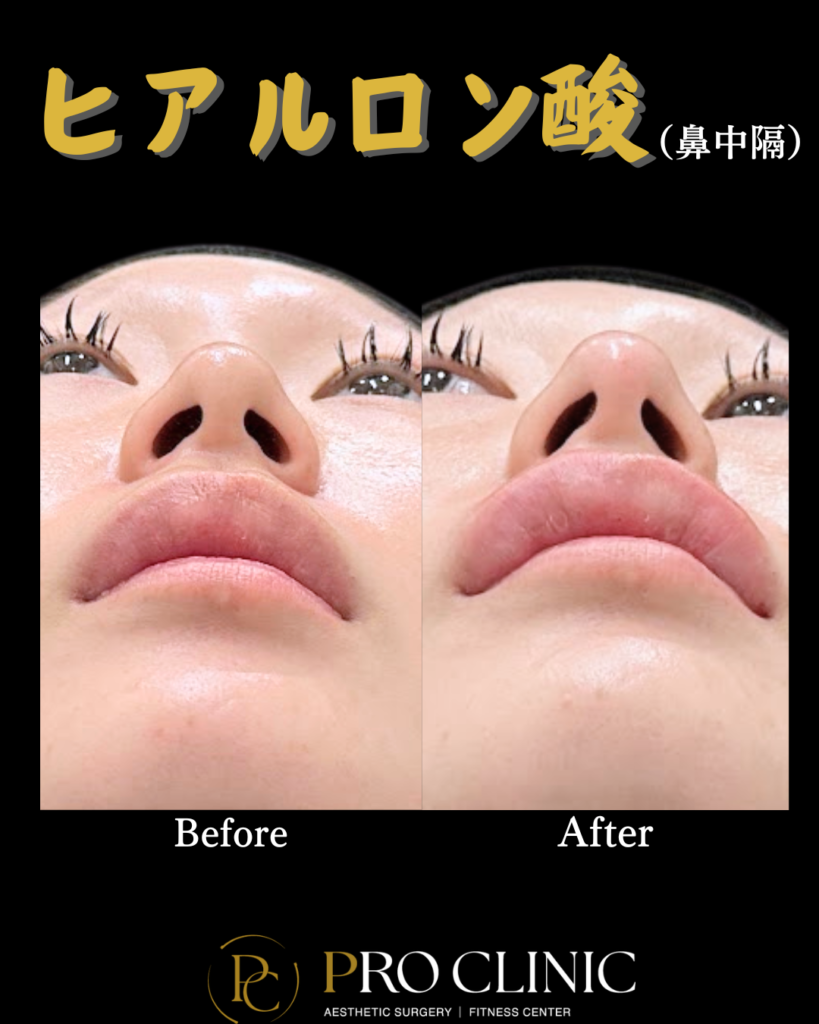 プロクリニックの鼻中隔ヒアルロン酸注入の症例（1か月後・正面）