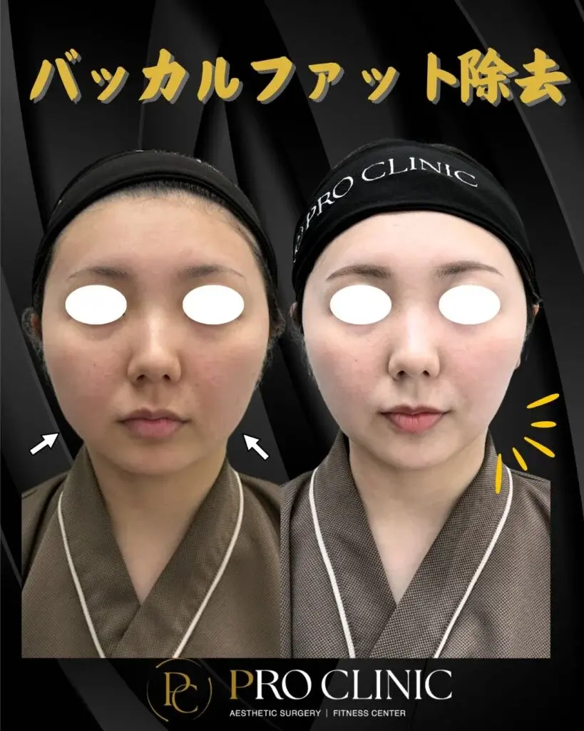 プロクリニックのバッカルファット除去の症例(3か月後・正面)