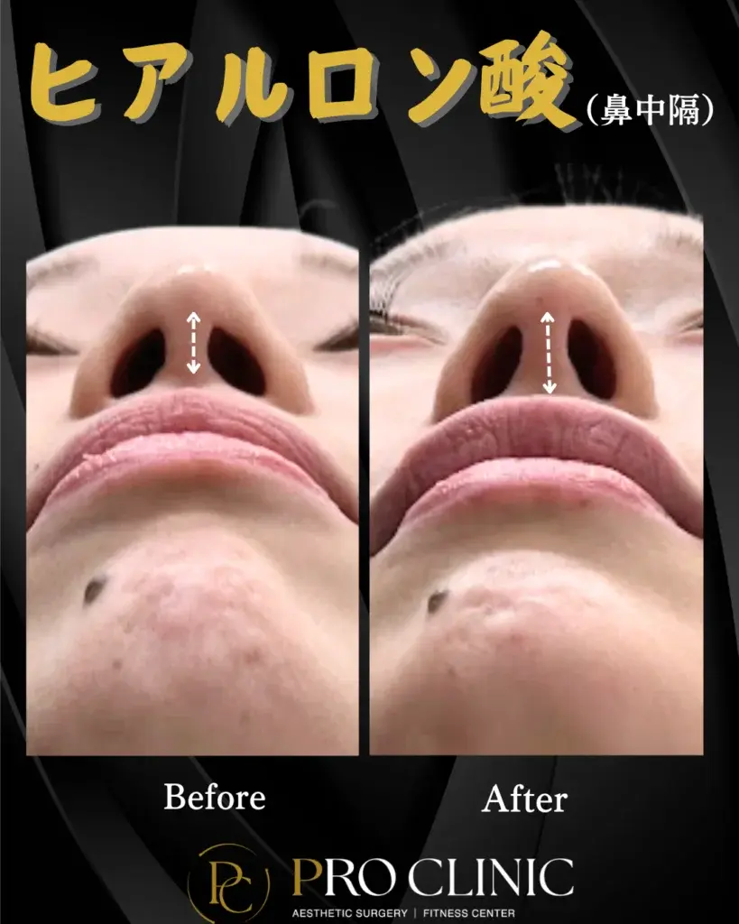 プロクリニックの鼻中隔ヒアルロン酸注入の症例（1か月後・正面）