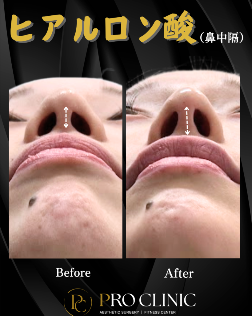 プロクリニックの鼻中隔ヒアルロン酸注入の症例（1か月後・正面）