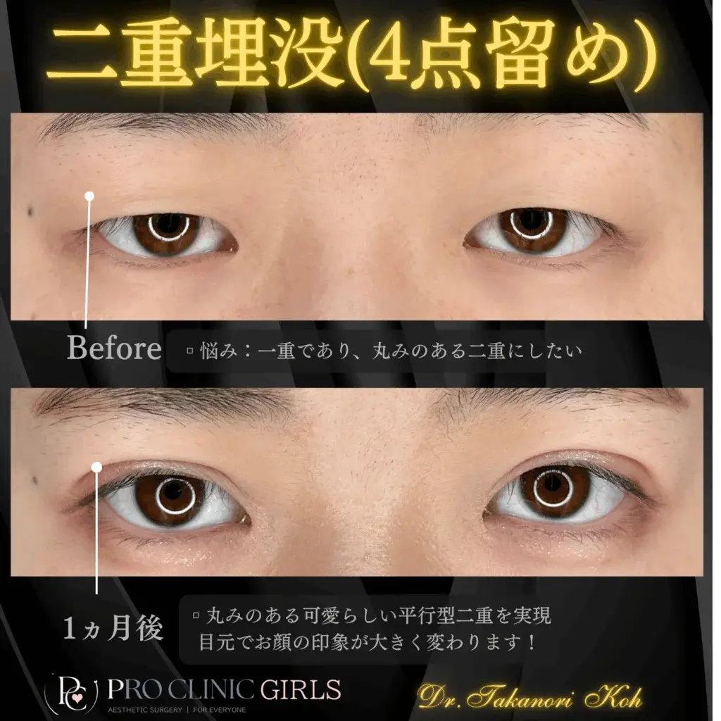 プロクリニックの二重埋没法の症例（1か月後・正面）