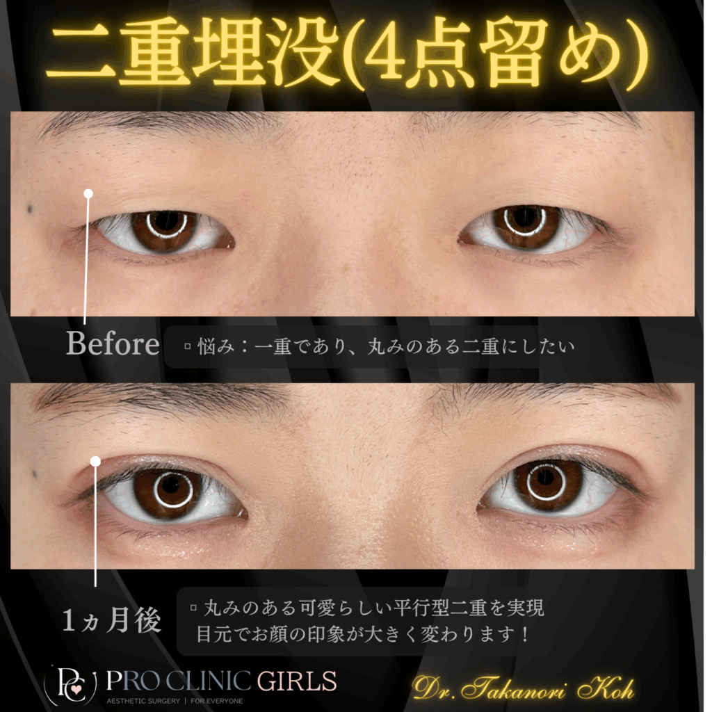 プロクリニックの二重埋没法の症例（1か月後・正面）