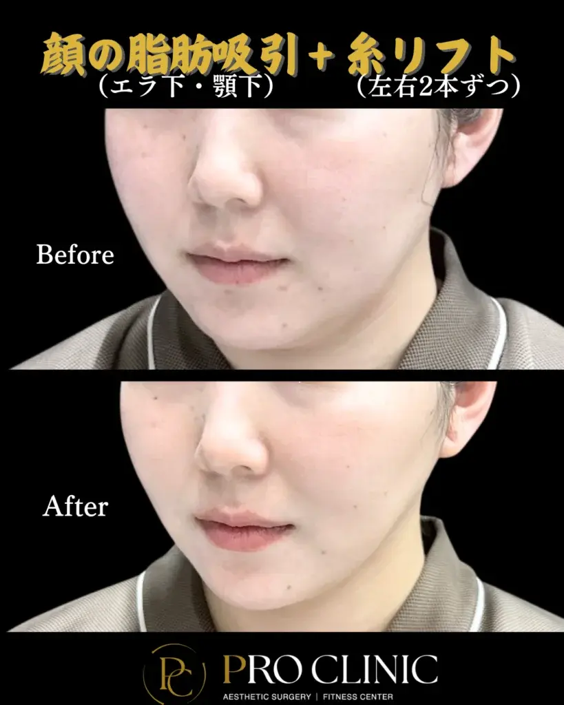 プロクリニックの顔の脂肪吸引+糸リフトの症例(1か月後・斜角)