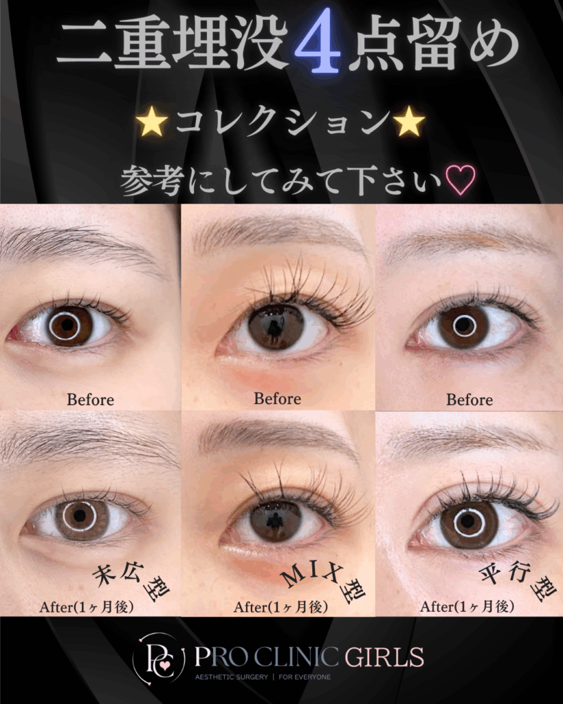 プロクリニックの二重埋没法の症例（1か月後・正面）