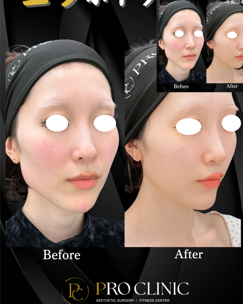 プロクリニックのエラボトックス注射の症例（1ヶ月後・斜角）