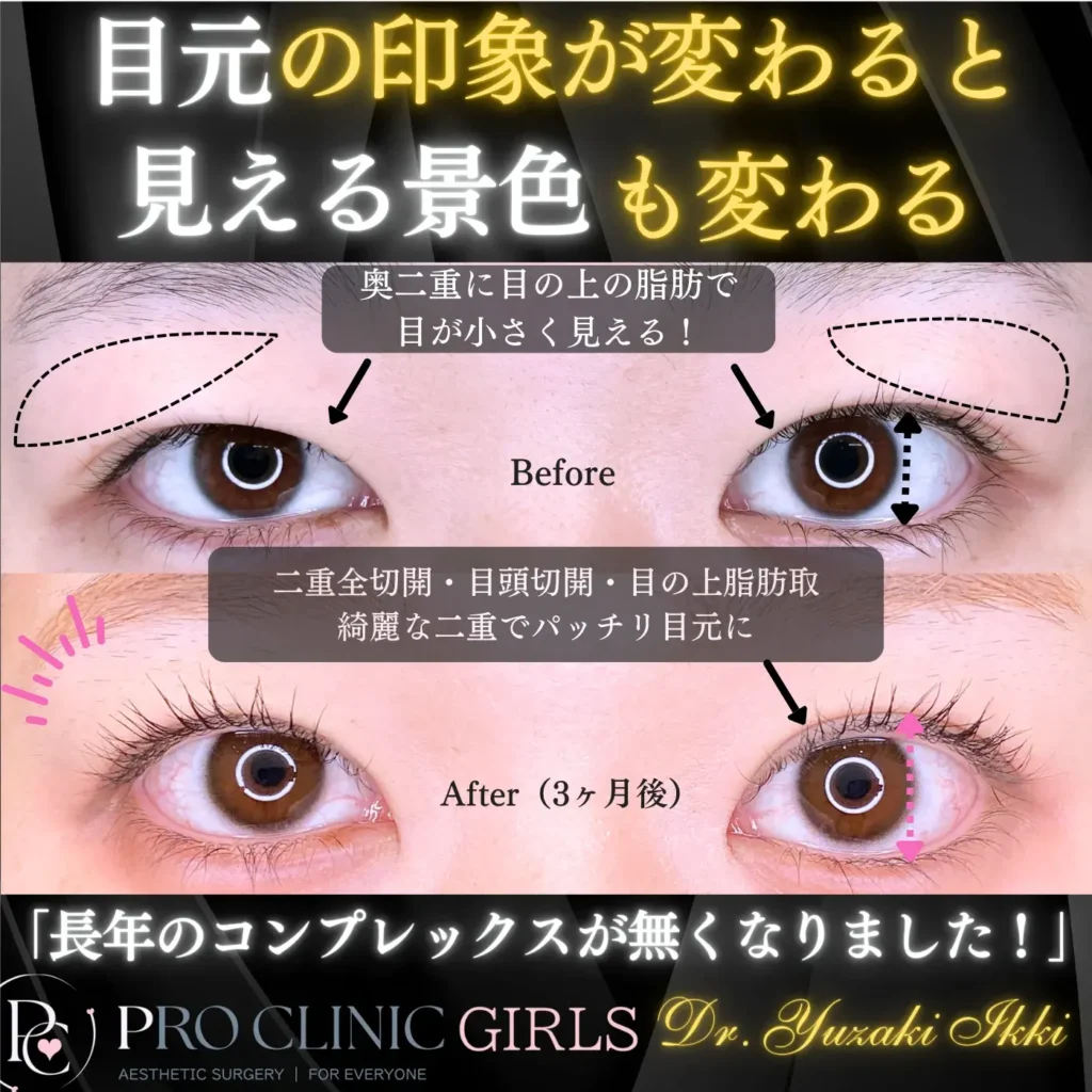 プロクリニックの二重形成（埋没法）の症例