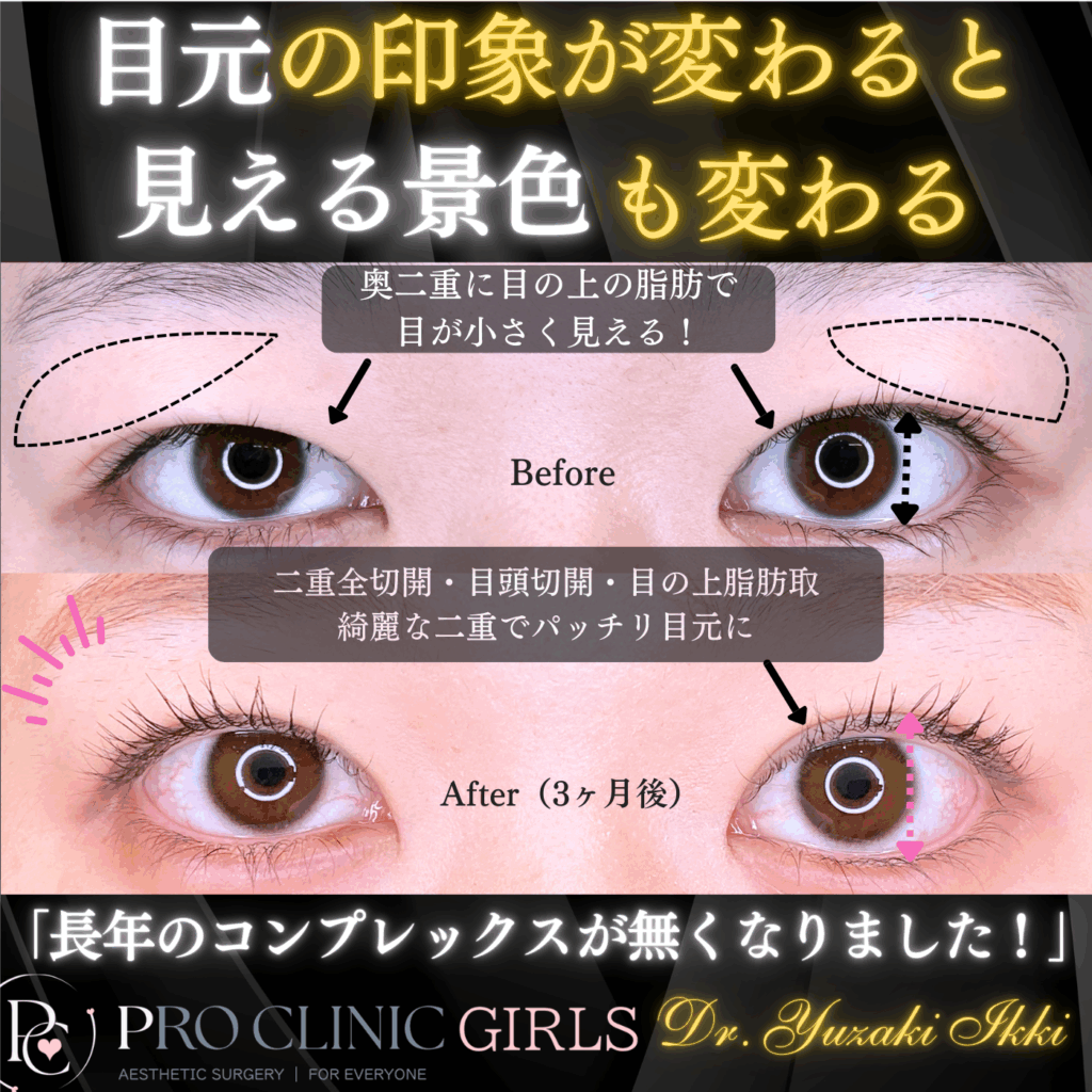 プロクリニックの二重形成（埋没法）の症例