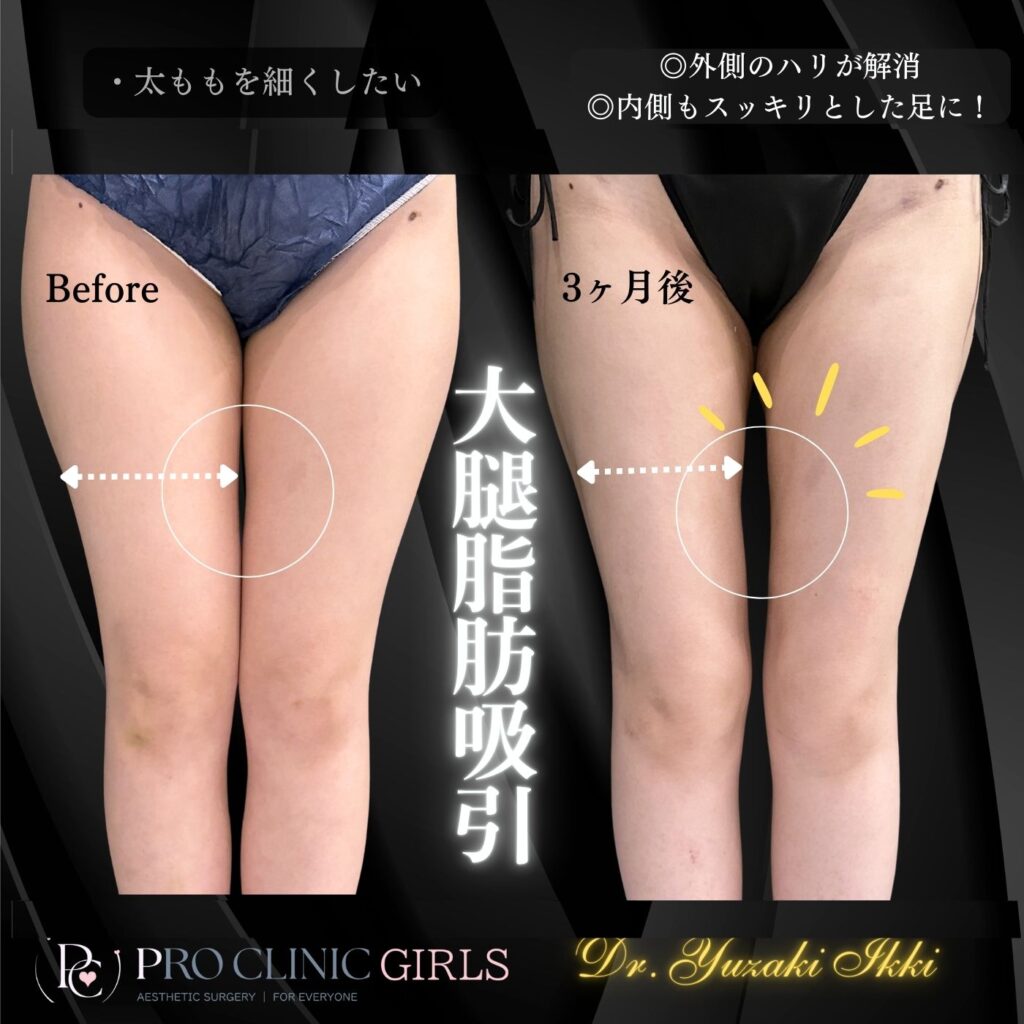 プロクリニックの大腿脂肪吸引の症例(3ヶ月後・正面)