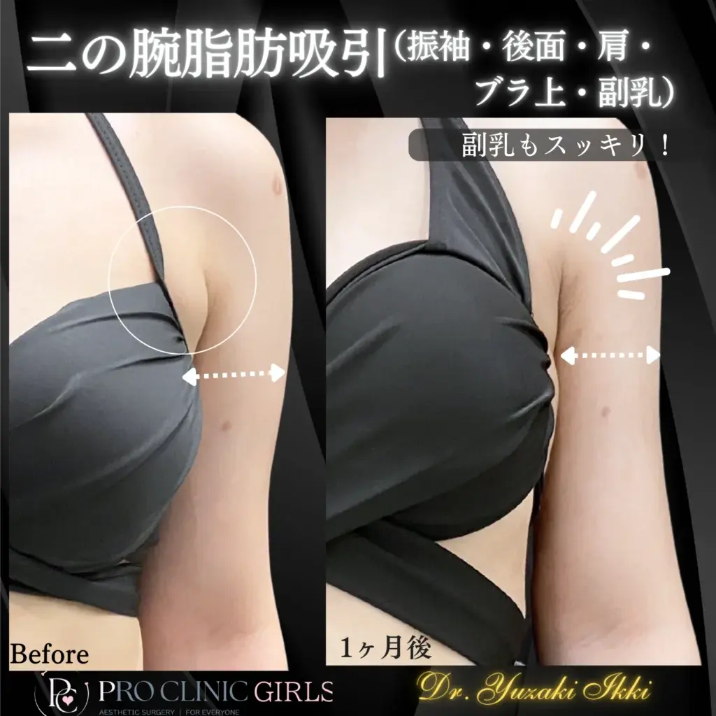 プロクリニックの二の腕脂肪吸引・副乳除去の症例（1ヶ月後・正面）