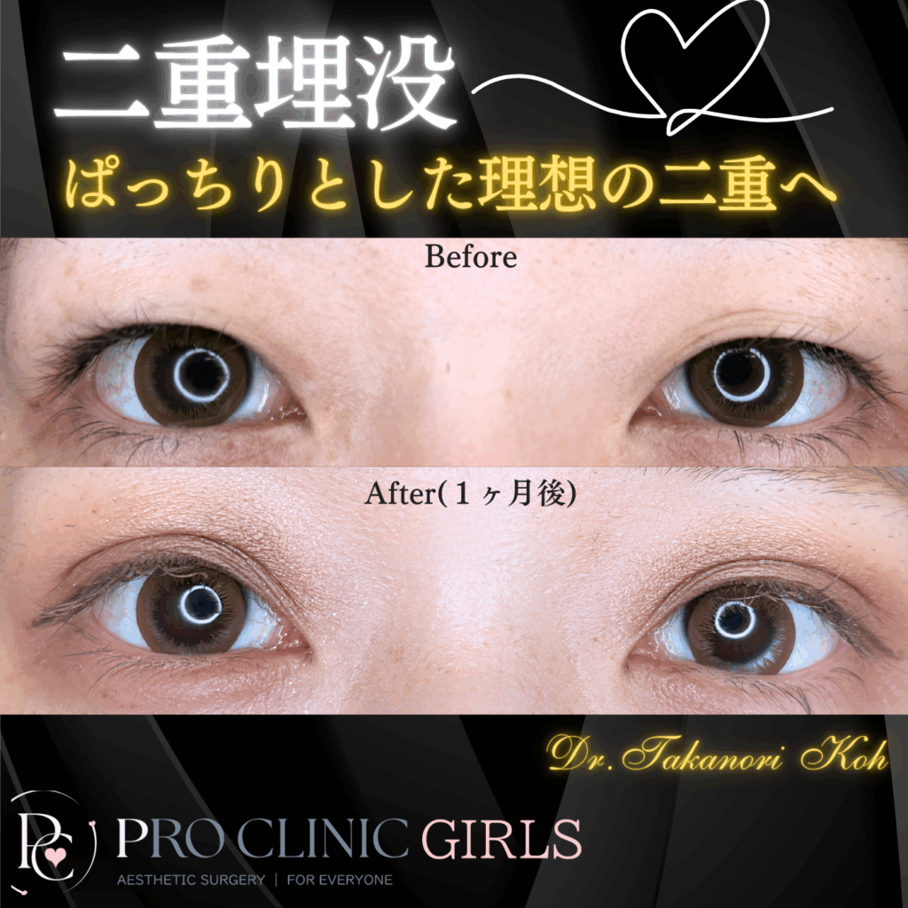 プロクリニックの二重埋没法の症例（1か月後・正面）