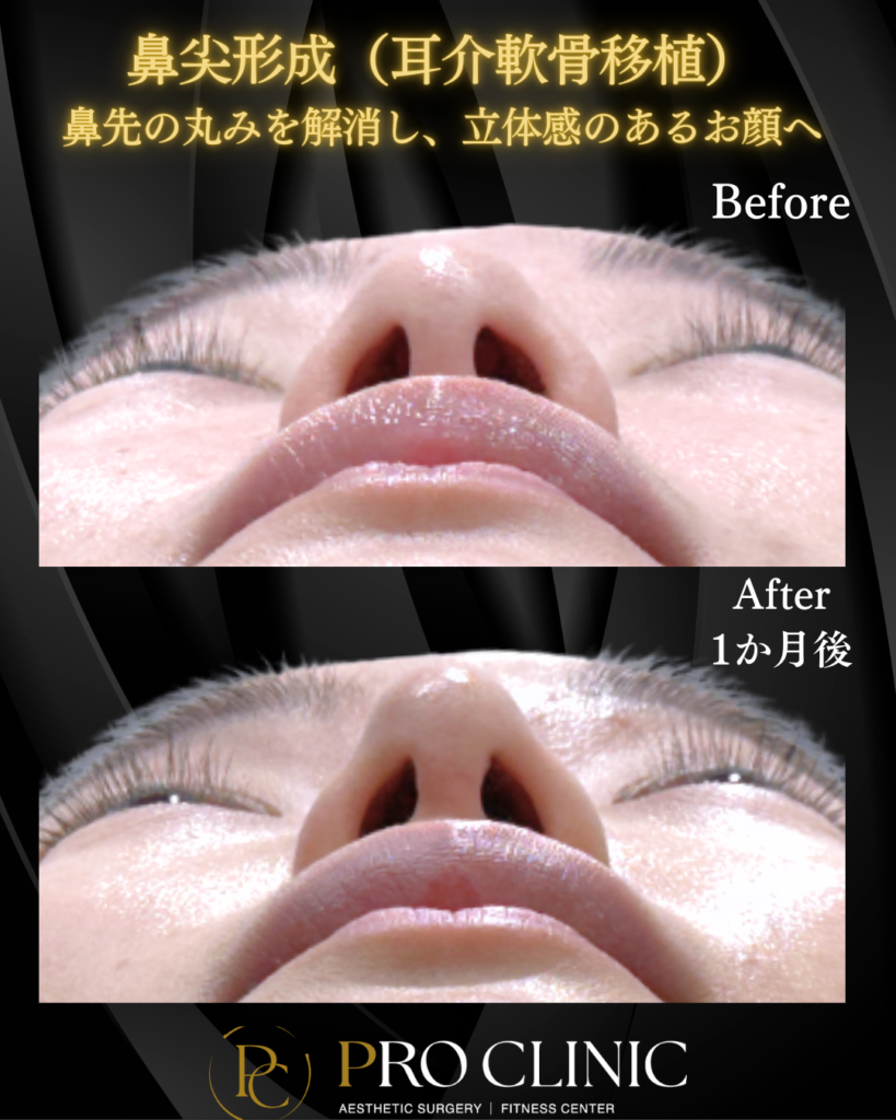 プロクリニックの鼻尖形成（耳介軟骨移植）の症例（1か月後・正面）