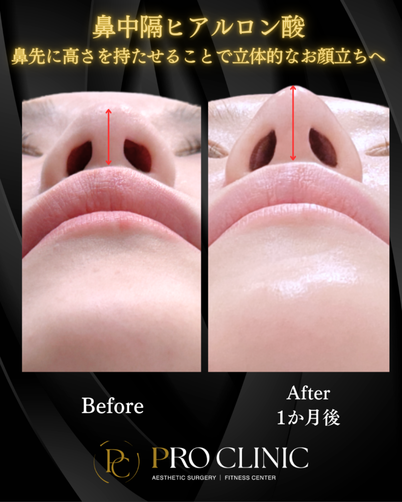 プロクリニックの鼻中隔ヒアルロン酸注入の症例（1か月後・正面）