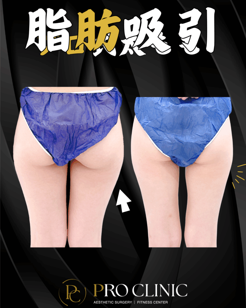 プロクリニックの太もも脂肪吸引の症例（3か月後・背面）