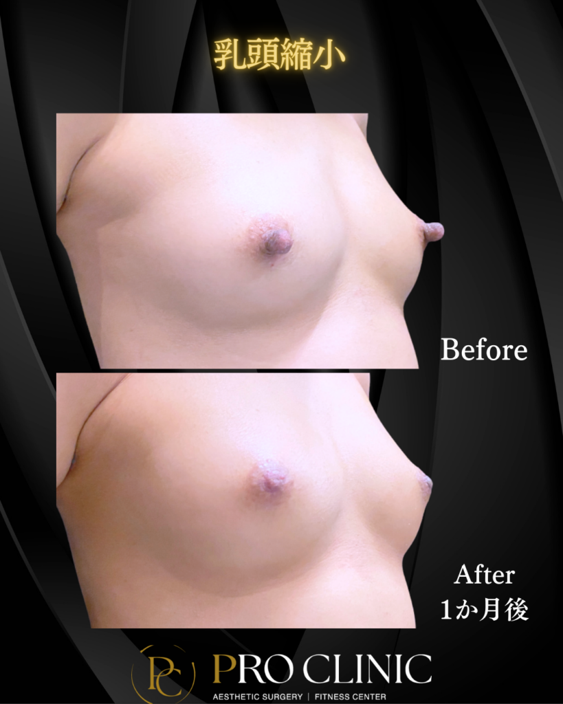 プロクリニックの乳頭縮小の症例(1か月後・斜角)