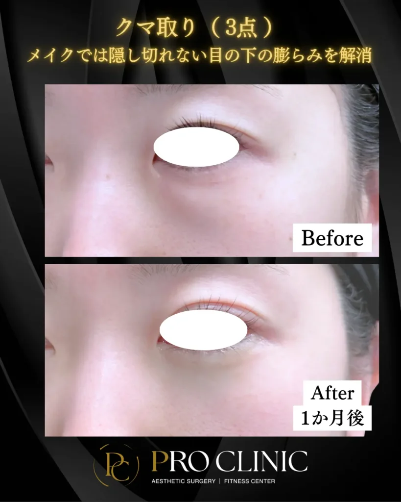 プロクリニックのクマ取り（3点）の症例（1か月後・斜角）