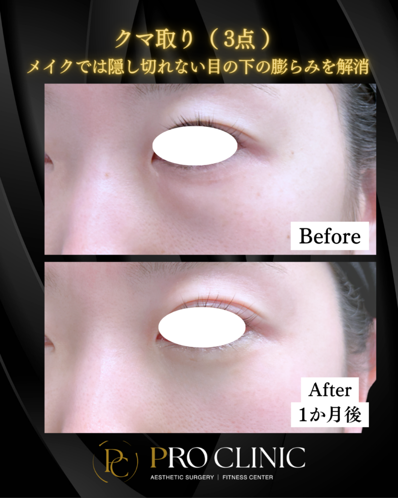 プロクリニックのクマ取り（3点）の症例（1か月後・斜角）