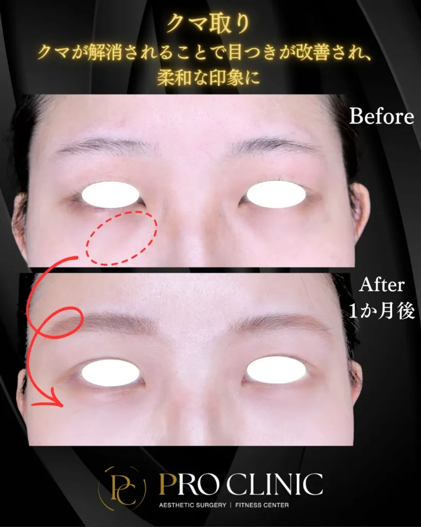 プロクリニックのクマ取りの症例（1か月後・正面）